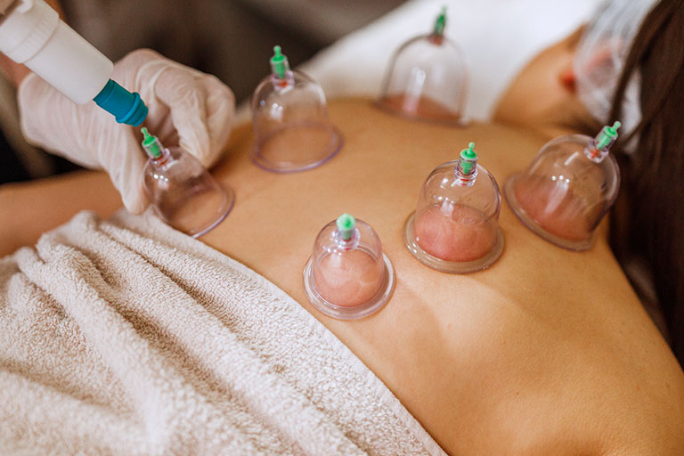Cupping Therapy