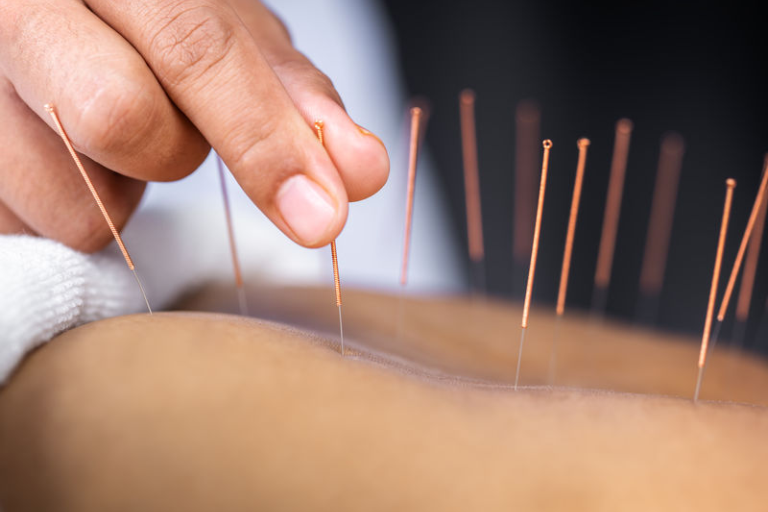 Acupuncture